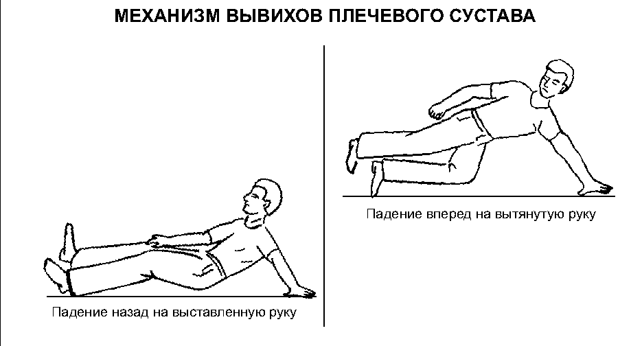 Как вправить вывихнутое плечо?