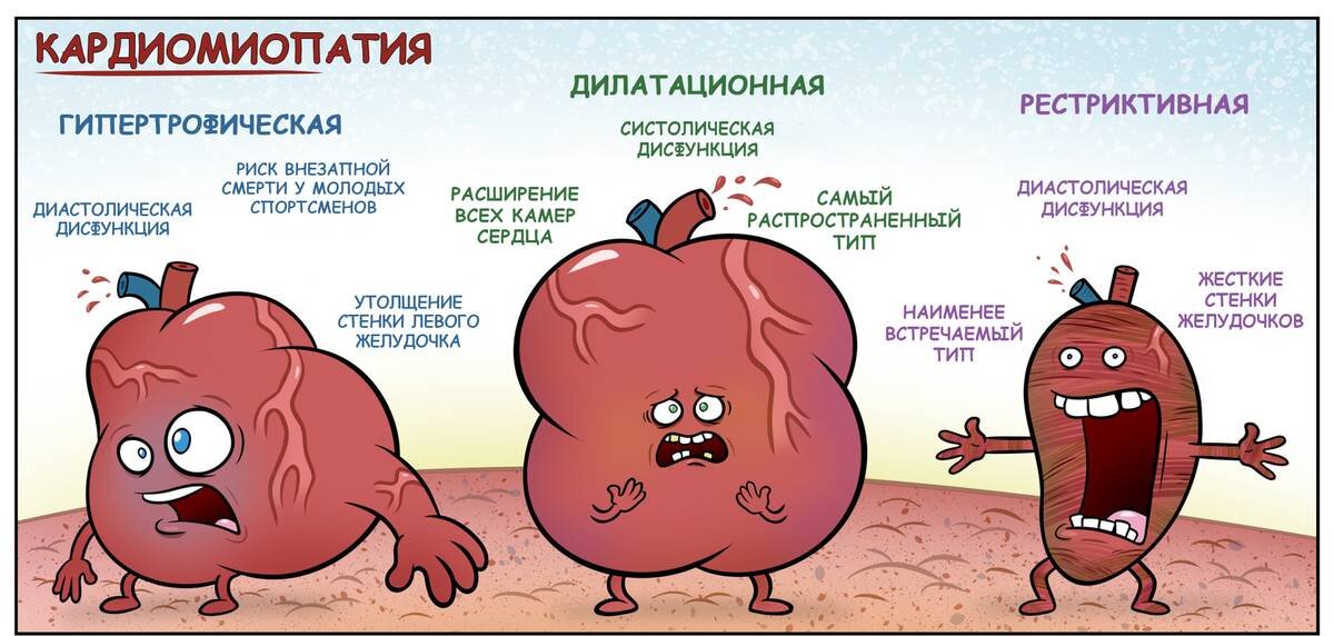 Кардиомиопатия что это такое. При дилатационной кардиомиопатии отмечается:. Кардиомиопатии дилатационная гипертрофическая рестриктивная. Кардиомиопатия сердца.