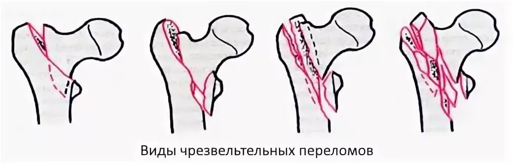 чрезвертельный перелом со смещением. чрезвертельный перелом бедренной кости классификация. чрезвертельный перелом со смещением отломков. закрытый чрезвертельный перелом правой бедренной кости. чрезвертельный перелом бедренной кости со смещением.