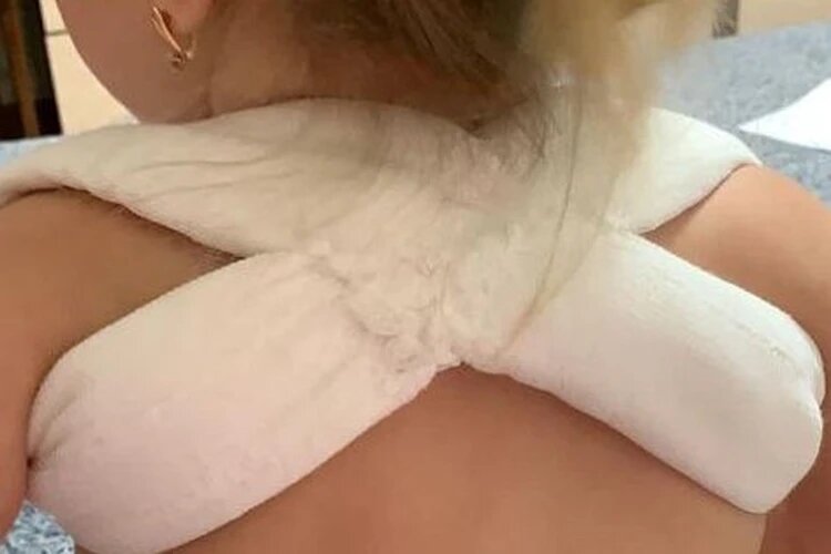 Перелом ключицы. Фото: страница Александры Н. в соцсети 
Читайте на WWW.UGRA.KP.RU: https://www.ugra.kp.ru/daily/27532/4799217/