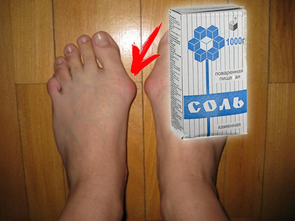 косточка на большом пальце, лечение косточки на пальце, здоровье, медицина, шишка на пальце ноги