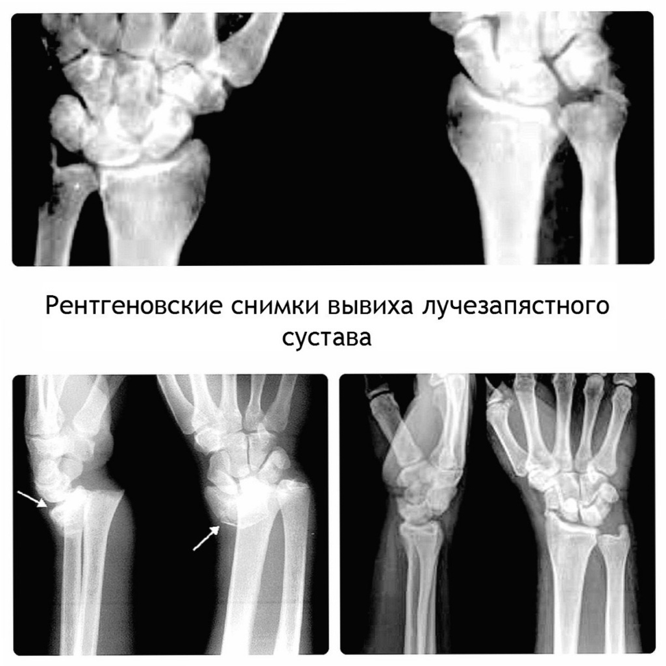 Как выглядит вывихнутая рука