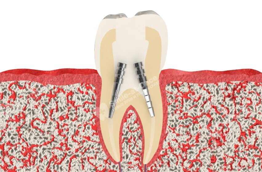 От зуба остался только корень: восстановление без имплантации