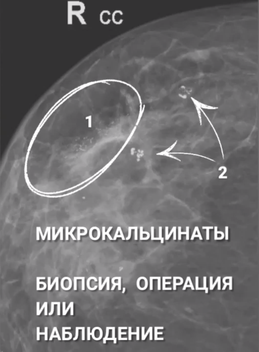 Микрокальцинаты молочной железы | Маммология и хирургия РНЦРР | Дзен