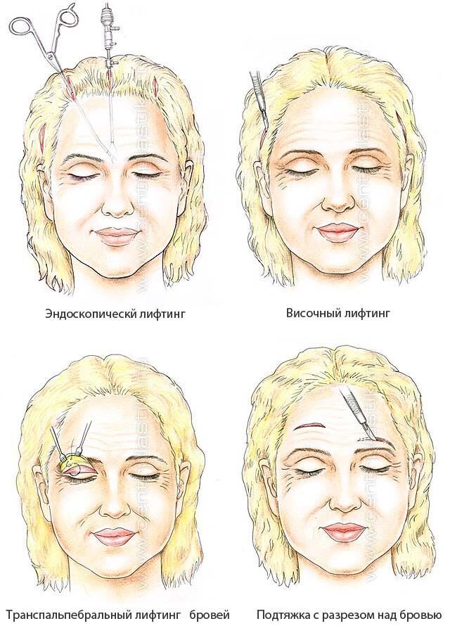 Подтяжка бровей операция фото Подтяжка лба и бровей. Что такое фронтлифтинг? Пластик-Клуб - все о пластике Дзе