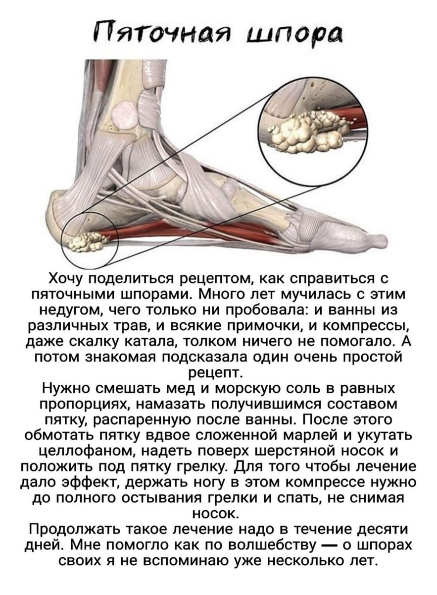 Шпора на пятке это. Препараты от шпоры на пятке.