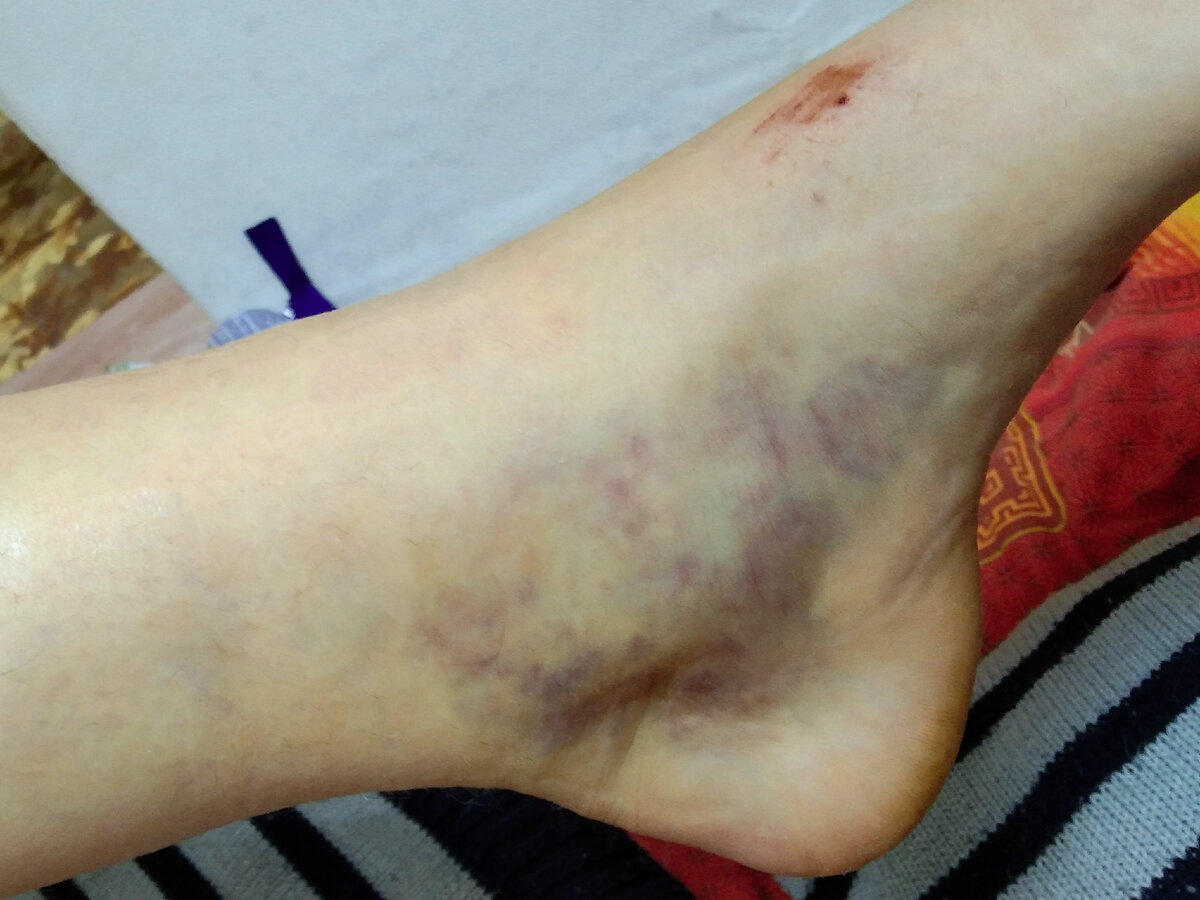 Вот так играючи, ломаем ногу в лодыжке и выходим из строя на шесть недель. Здесь и далее фото автора.