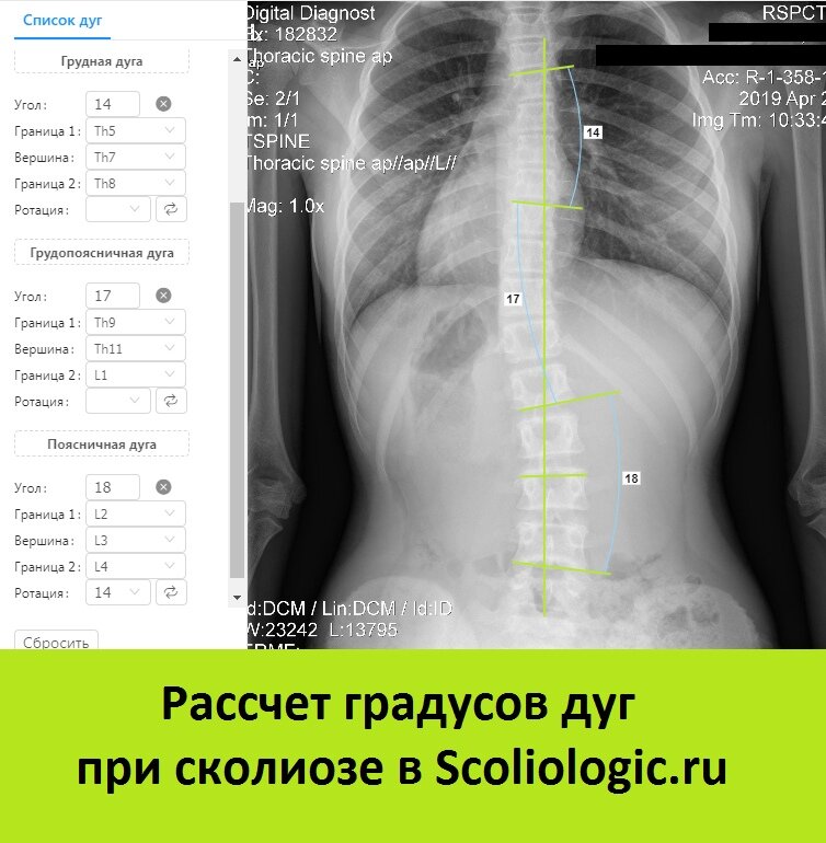 Рентген грудного отдела что показывает