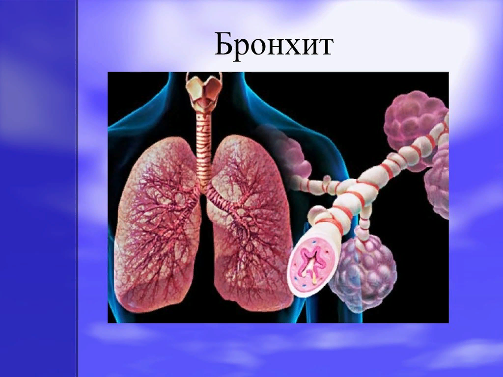 Заболевание бронхит. Бранхии. Бронхитол.