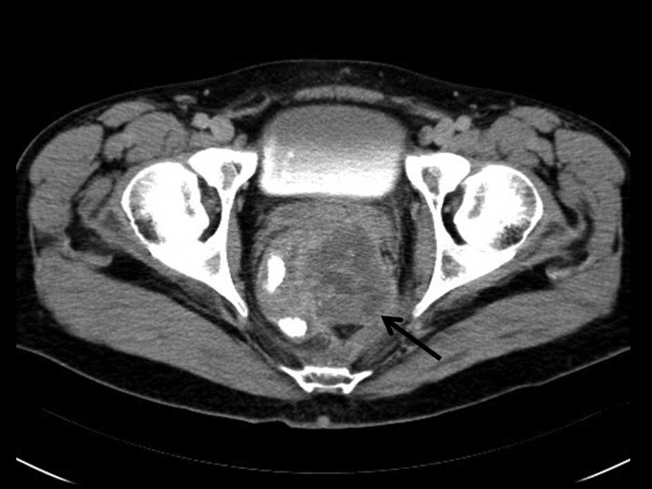 Кт малого таза с контрастом у мужчин. Опухоль предстательной железы кт. Магнитно-резонансная томографии (мрт) предстательной железы. Предстательная железа на томограмме. Кт предстательной железы с контрастированием.