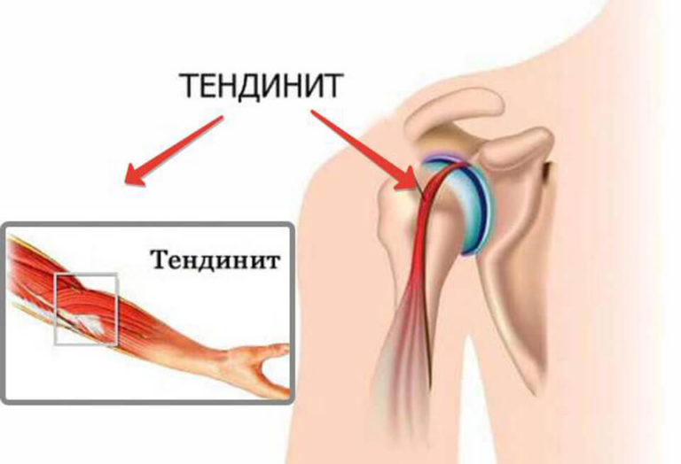 Тендинит сухожилия. Тендинит сухожилия бицепса плечевого сустава. Тендинопатия сухожилия плечевого сустава. Тендинит трехглавой мышцы плеча.