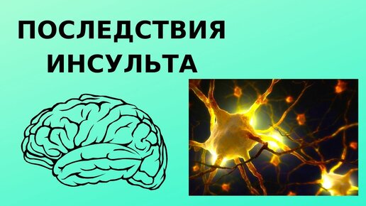 Последствия инсульта