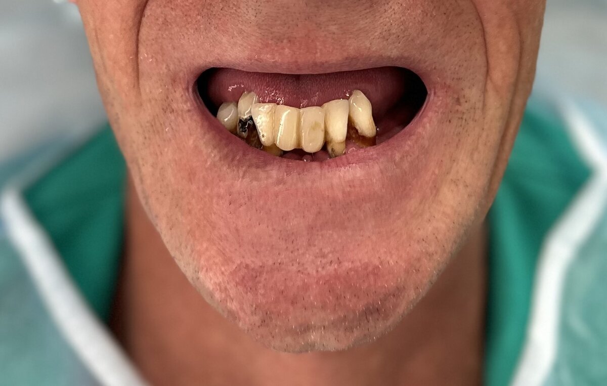 Протез убрали.