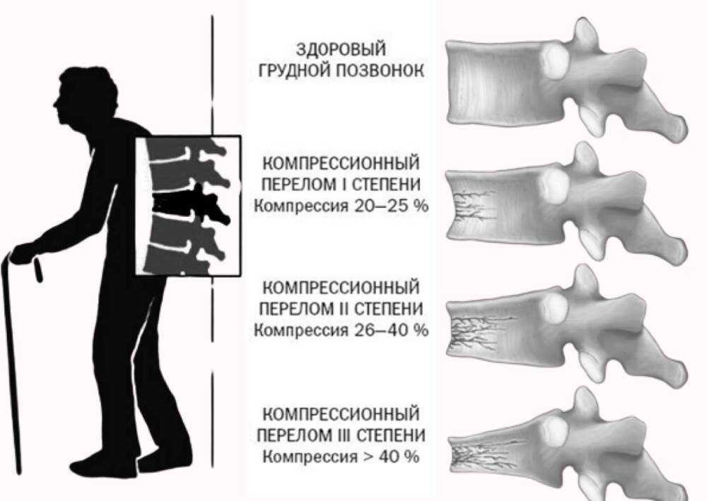 Реабилитация позвоночника