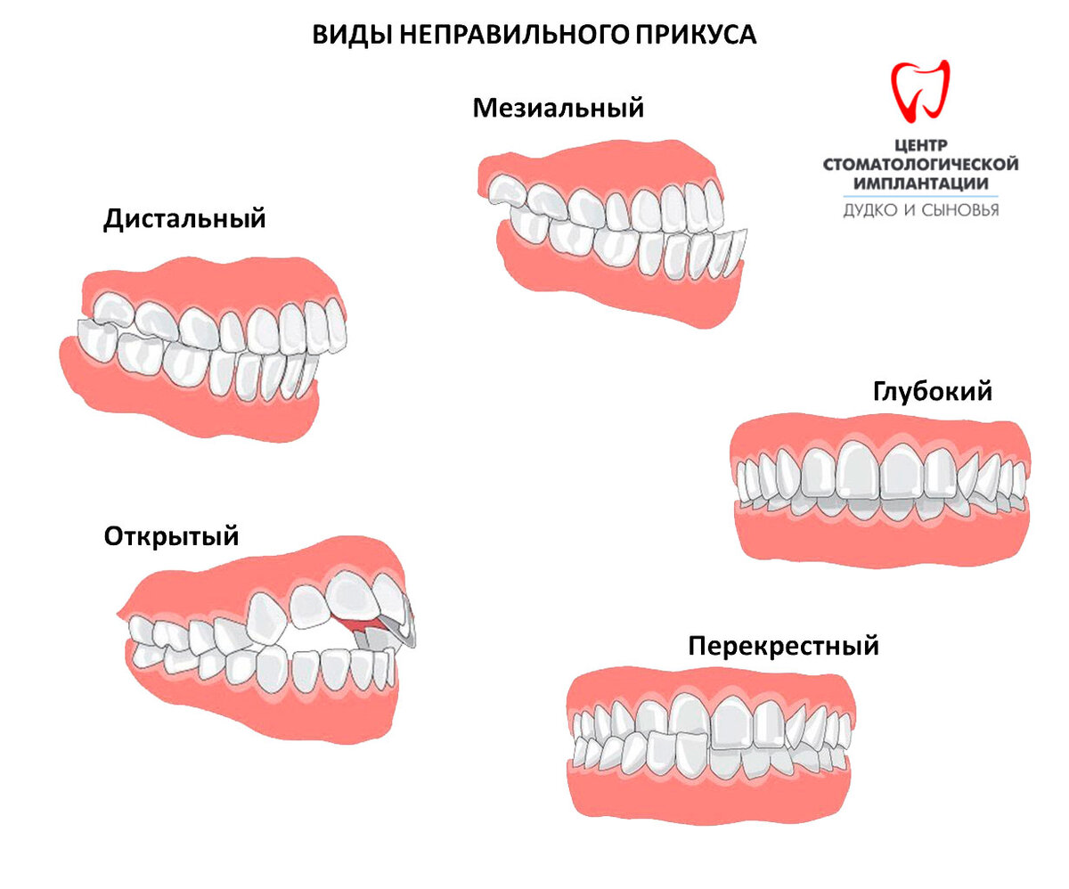 неправильный прикус