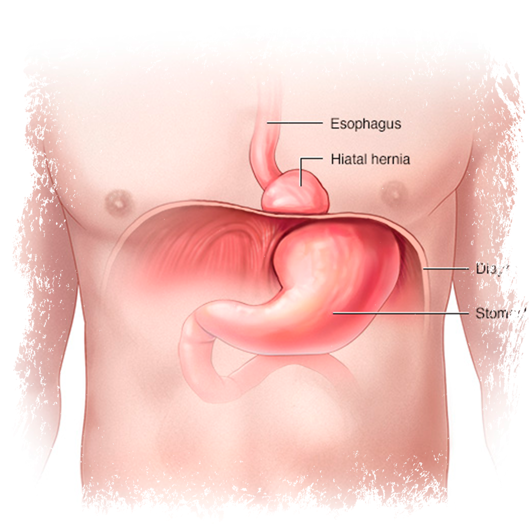 Грыжа между желудком пищеводом