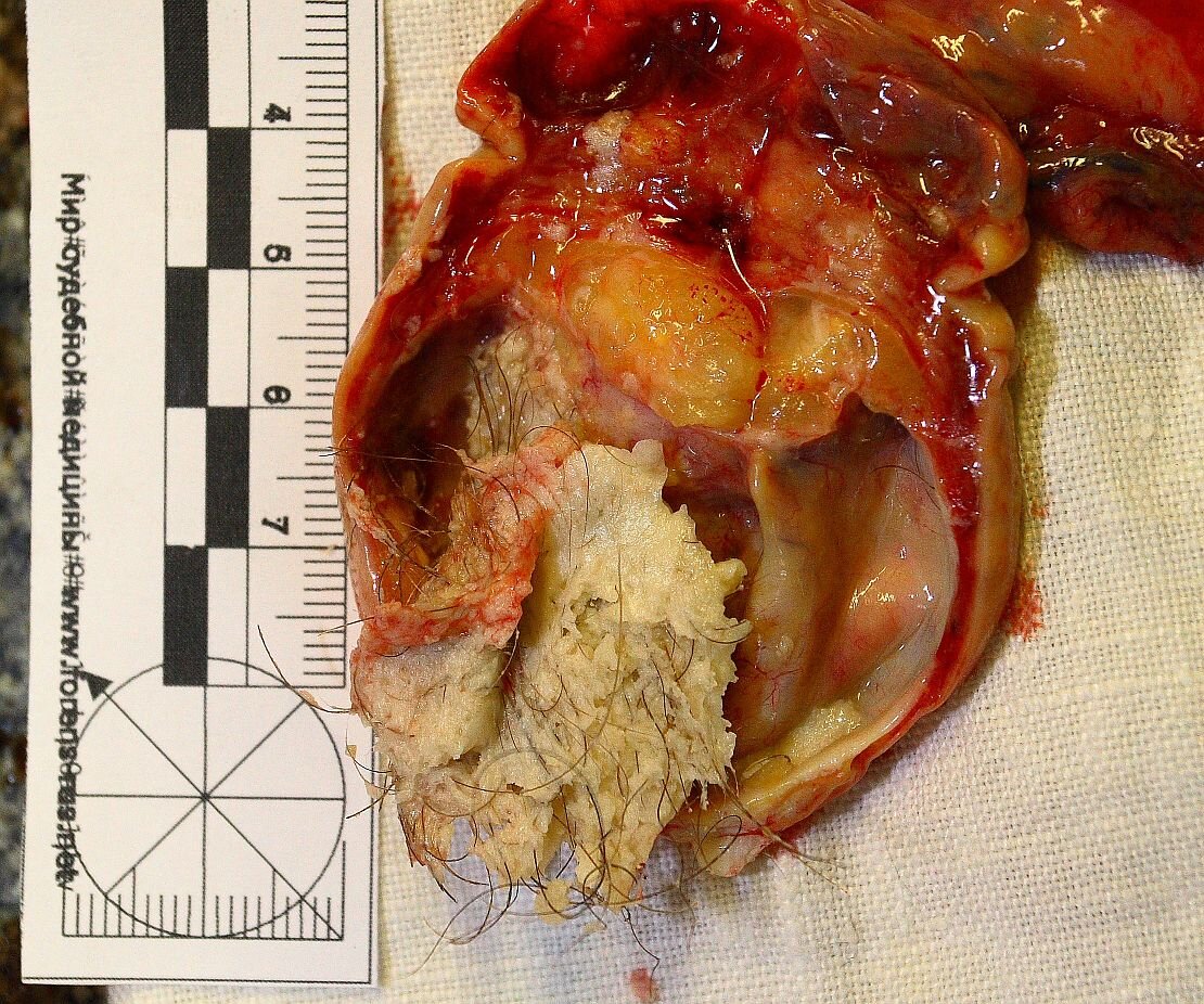 Тератома яичника