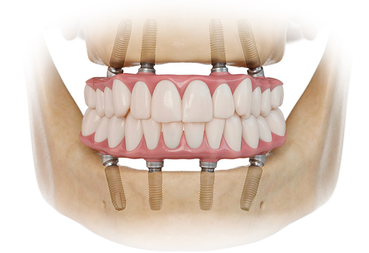 При полном отсутствии зубов несъемный протез, как правило, можно установить на 4-6 имплантах