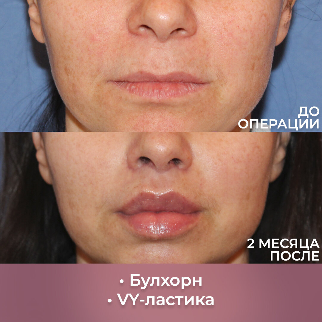 Сочетание булхорн + vy-пластика. Пластический хирург: Левицкая М.Г.