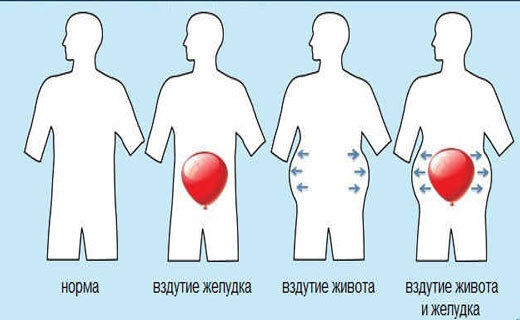 Как быстро избавиться от вздутия живота без лекарств