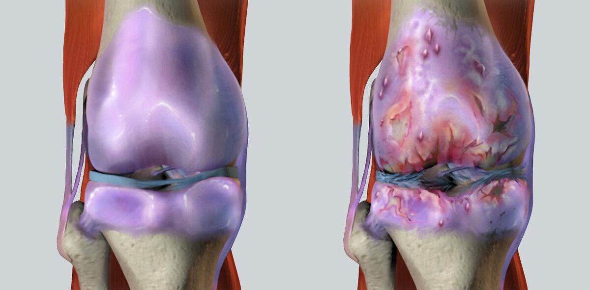 Слева – здоровый коленный сустав, справа – пораженный остеоартритом