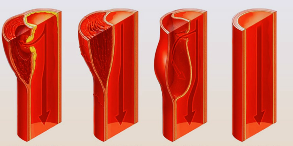 Расслоение аневризмы аорты.
