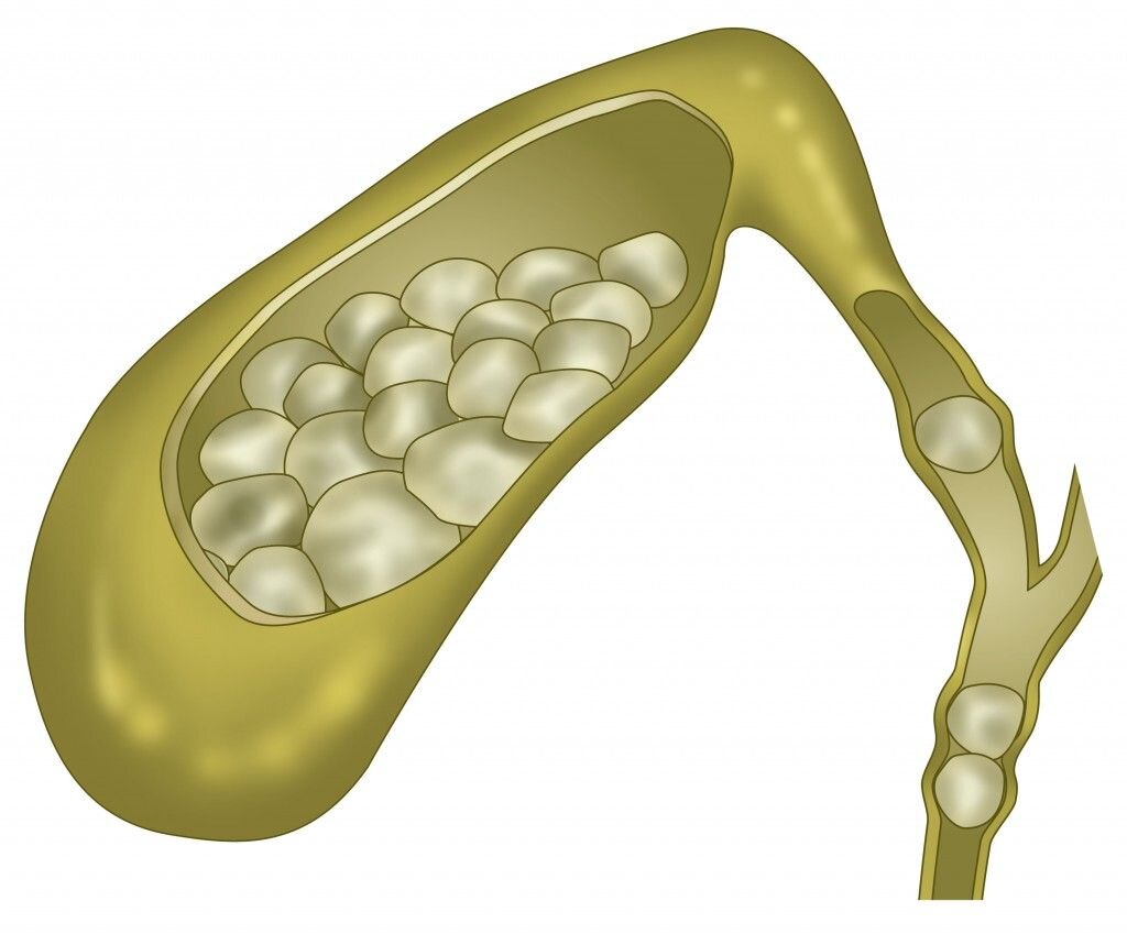Болезнь желчного пузыря камни. Желчекаменная болезнь холелитиаз. Желчнокаменная болезнь (ЖКБ). Желчнокаменная болезнь (холелитиаз). Желчекаменная болезнь холедохолитиаз.