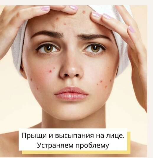 Акне – деликатная, но довольно распространенная проблема, которая возникает у людей разных возрастов и половой принадлежности.