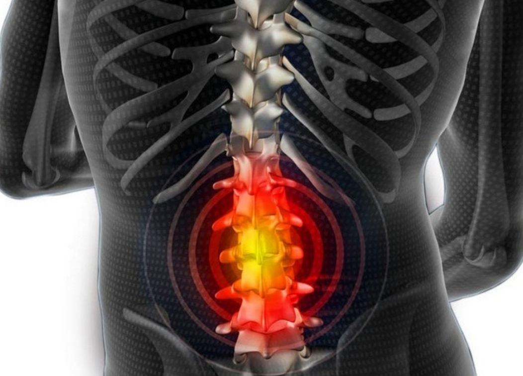осложнения поясничной грыжи