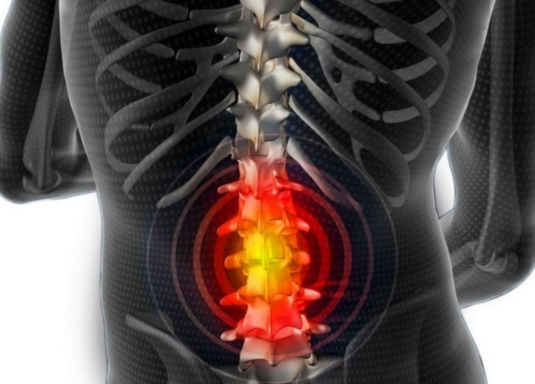 Грыжа позвоночника фото человека как выглядит