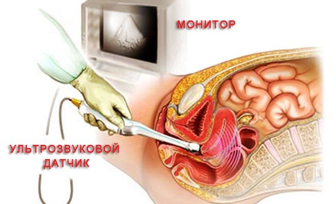 Трансвагинальное УЗИ.  Один из самых информативных методов исследования органов малого таза женщины.