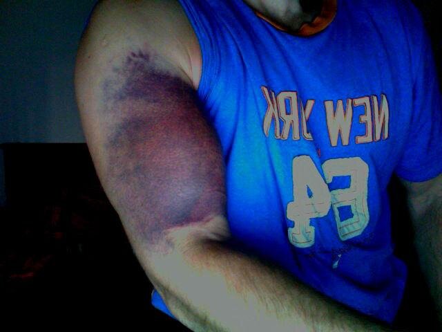 Разрыв бицепса