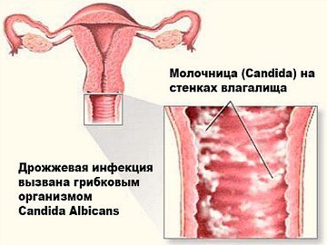 Можно ли вылечить молочницу кефиром и вообще стоит ли его пить?