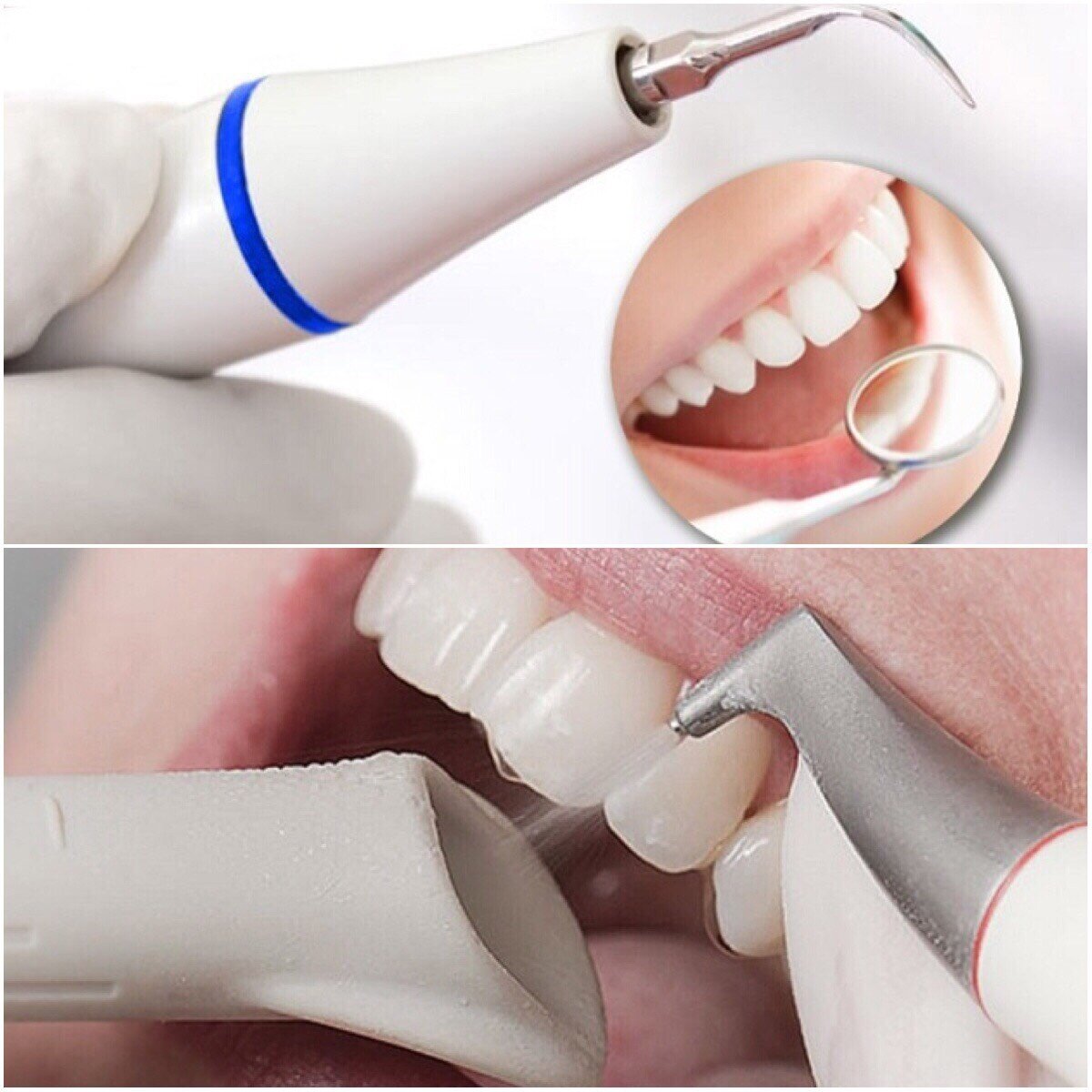 Как стоматологи делают чистку зубов. Профгигиена (ультразвук + Air-Flow). Профгигиена полости рта Air Flow. Ультразвук + Air Flow+фторирование.