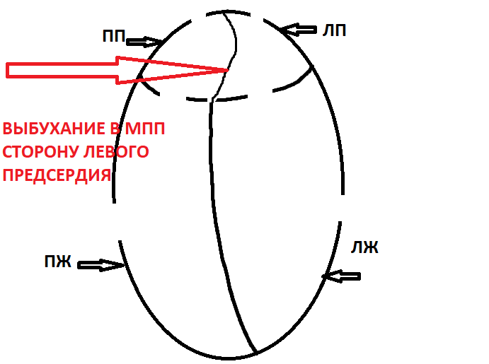 Дефект межпредсердной перегородки