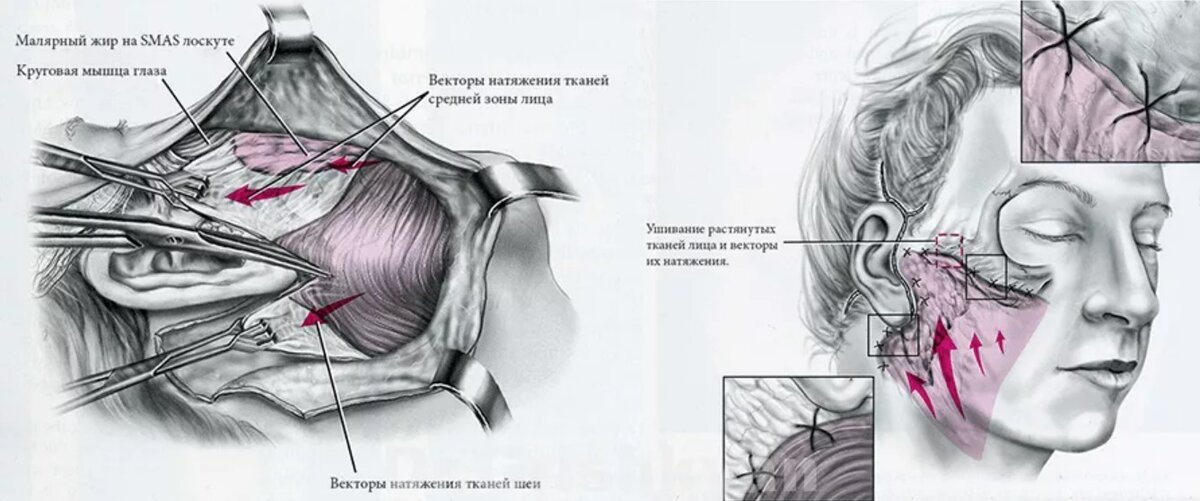 Схема SMAS-пластики. Фото с сайта Д.Р. Гришкяна. Имеются противопоказания, требуется консультация специалистов