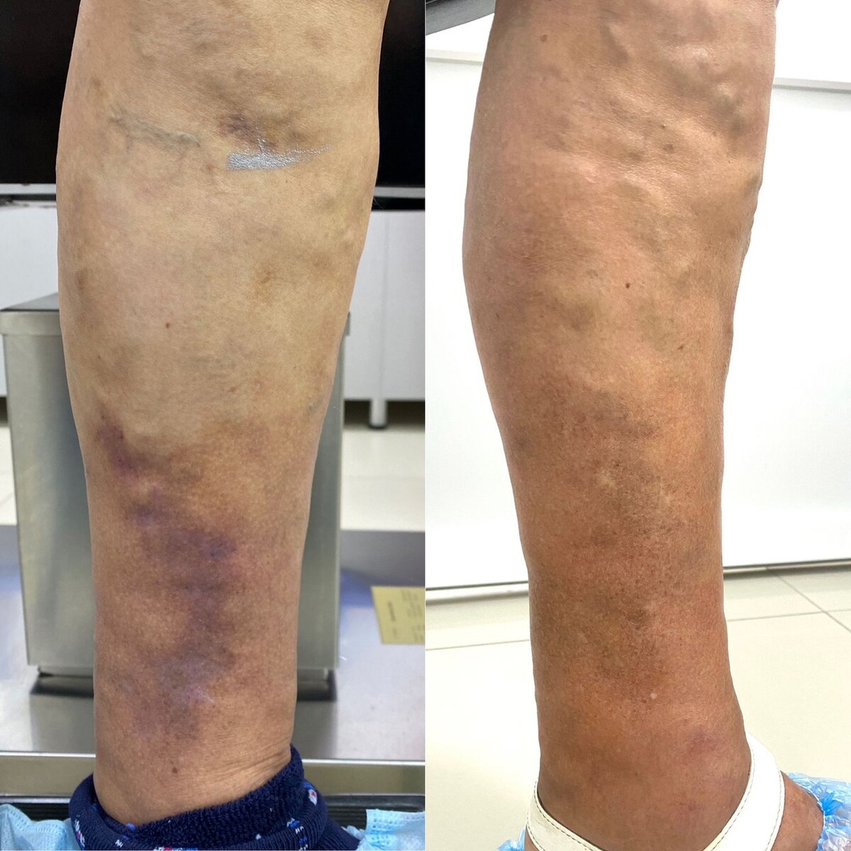 До и после лечения варикозной болезни