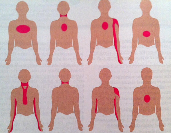 Иррадиация боли сердца