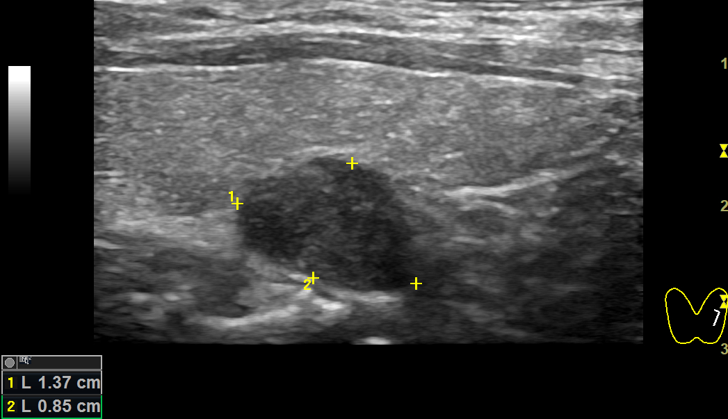 Аденома паращитовидной железы на УЗИ. Аденома паращитовидных желез на УЗИ. Паращитовидные железы на УЗИ норма. Узел паращитовидной железы на УЗИ.