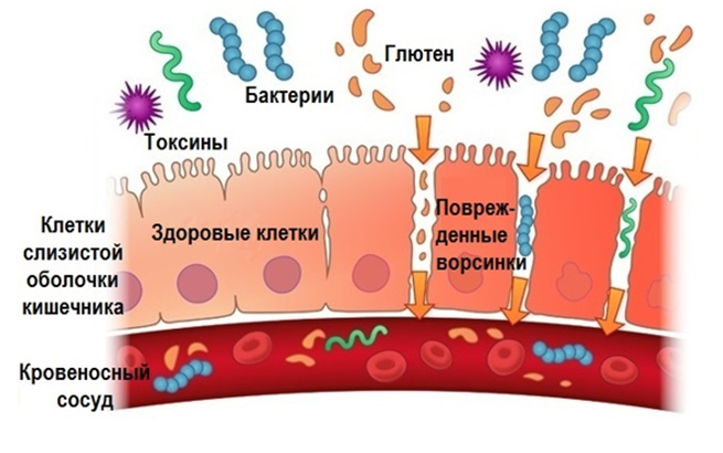  Синдром негерметичной кишки