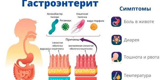 Ротавирус - симптомы, лечение и профилактика