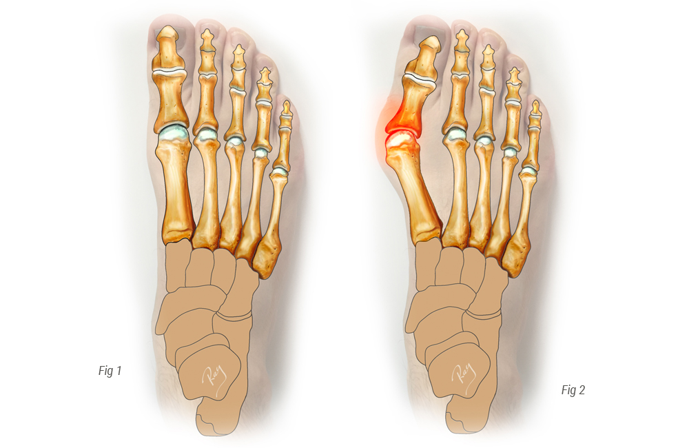 Слева – нормальная стопа, справа – деформированная hallux valgus
