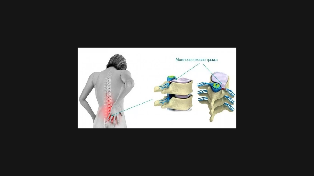 Матрас межпозвоночная грыжа