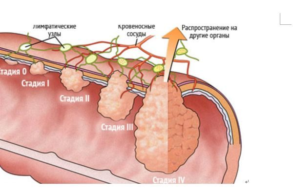 Можно ли излечиться от рака