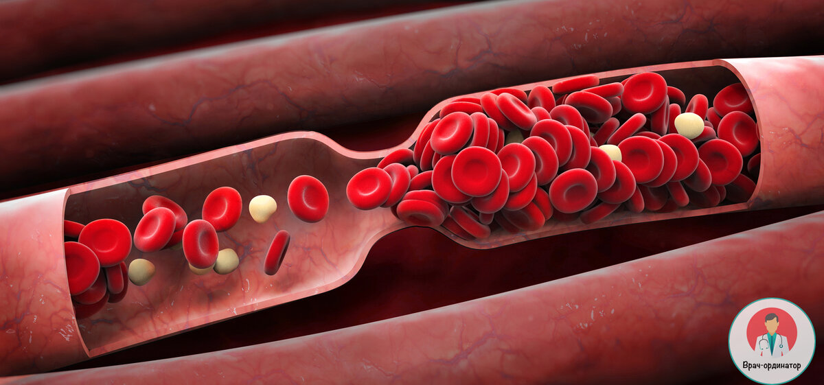 Тромб в сосуде