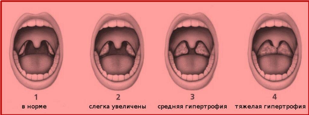 Гланды и аденоиды картинки где находятся