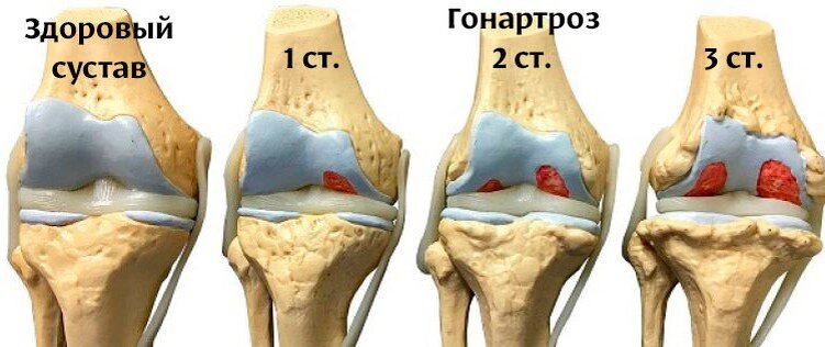 Нормальный сустав и его изменения при гонартрозе
