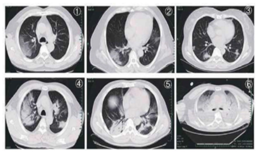 На КТ ОГК: характерные признаки COVID-19: Рис. 1, 2. Субплеврально очаги уплотнения по типу «матового стекла».
Рис. 3. Узлы и очаговая экссудация.
Рис. 4, 5. Многоочаговые уплотнения в пораженных участках.
Рис. 6. Диффузное уплотнение, т.н. «белое легкое».