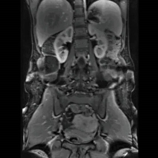 Мрт кишечника волгоград. Мрт лимфоузлов малого таза. Мрт энтерография кишечника. Кт энтерография тонкого кишечника. Мр энтерография тонкого кишечника.