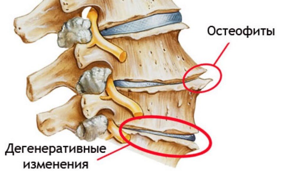 Отростки в шейном отделе